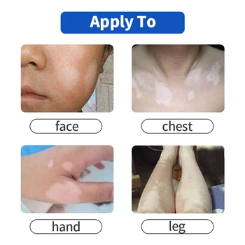 Lekárske Leukoplakia Ochorenia Krém Vitiligo Pigment, Melanín, Podpora Liniment Pokožky White Spot Repair Treatment omietky