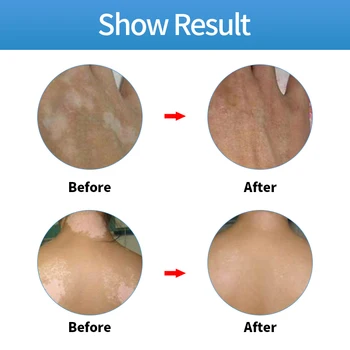 Lekárske Leukoplakia Ochorenia Krém Vitiligo Pigment, Melanín, Podpora Liniment Pokožky White Spot Repair Treatment omietky