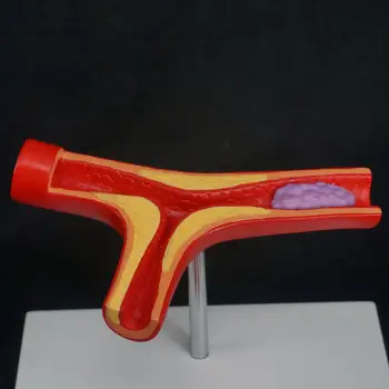 Ľudské Tepien Je Ateroskleróza Arteriosklerózy Model Trombus Cievne Lekárske Model Učebné Zdroje